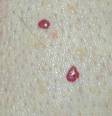 cherry angioma